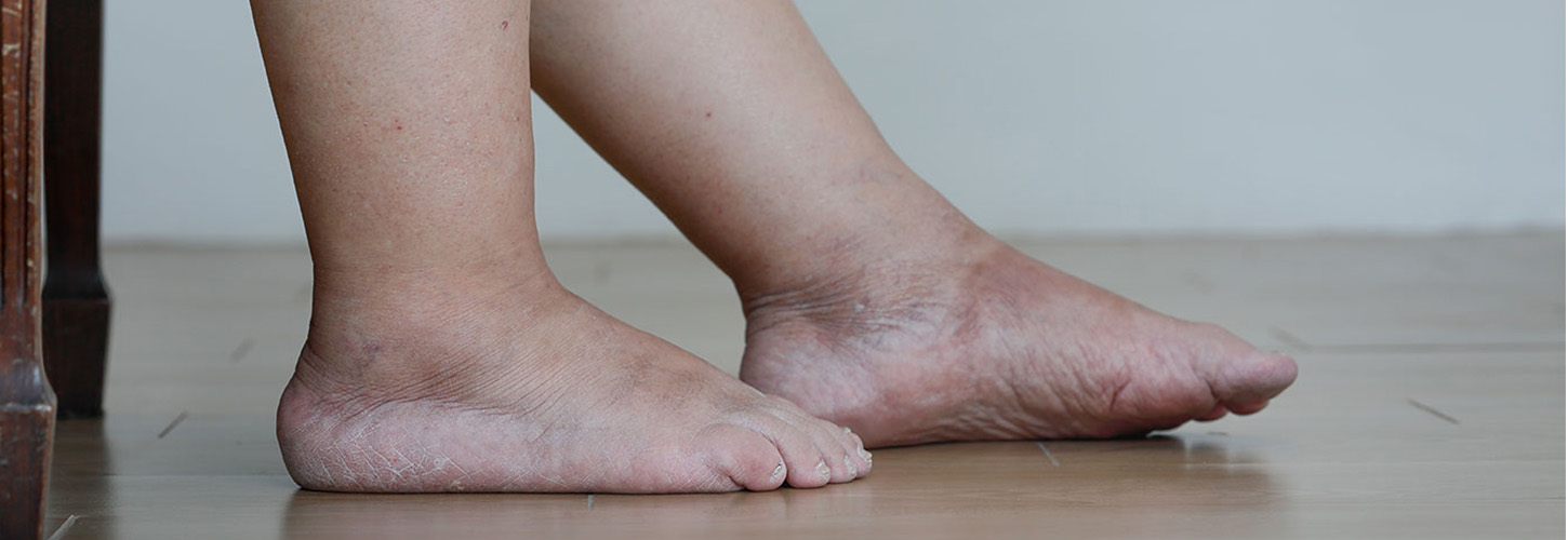 Here Are the Best Extra Stretchy Socks for Swollen Feet